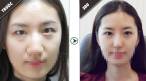Hình ảnh trước và sau khi thực hiện bấm mí mắt