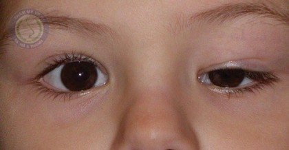 Nguyên nhân và cách chữa trị sụp mí mắt