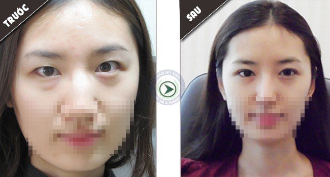 Trước và sau bấm mí mắt của Hồng Hạnh