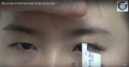 Khách hàng đo và cắt mí mắt tại Hà Thanh